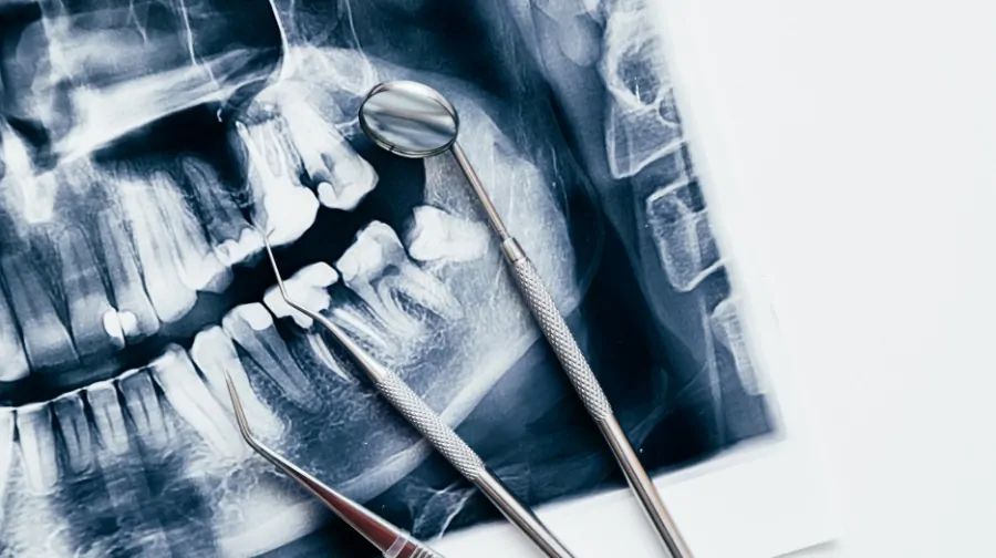 Dental X-ray with examination tools placed on top, representing patient care and treatment access
